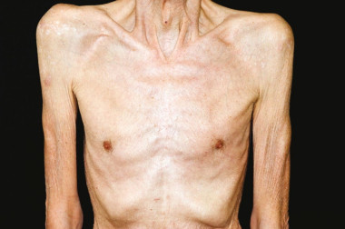 Hội chứng suy mòn Cachexia: Nguyên nhân, triệu chứng và cách điều trị